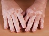 10 Natural Remedies To Treat Vitiligo