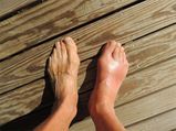 Bunions: Causes, Symptoms, Diagnosis, Treatment And Prevention