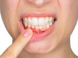 Swollen Gums: Causes, Symptoms And Treatment