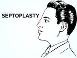 Everything You Need To Know About Septoplasty