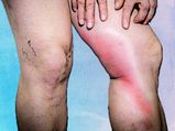 Phlebitis: Causes, Symptoms, Diagnosis & Treatment