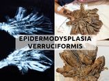 Epidermodysplasia Verruciformis (EV): Causes, Symptoms, Diagnosis And Treatment