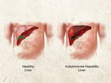 Autoimmune Hepatitis: Causes, Symptoms, Diagnosis & Treatment