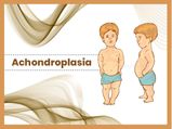 Achondroplasia: Causes, Symptoms, Diagnosis And Treatment