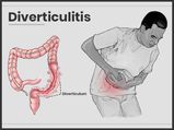 Diverticulitis: Symptoms, Causes, Diagnosis And Treatment