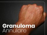 Granuloma Annulare: Types, Causes, Symptoms, Diagnosis And Treatment