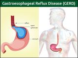 Gastroesophageal Reflux Disease (GERD): Symptoms, Causes, Diagnosis, Treatment & Prevention