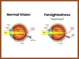 Farsightedness (Hyperopia): Causes, Symptoms, Diagnosis And Treatment