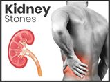 Kidney Stones: Symptoms, Causes, Diagnosis, Treatment And Prevention