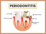 Periodontitis: Symptoms, Causes, Risk factors, Treatment And Prevention