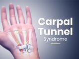 Carpal Tunnel Syndrome: Causes, Symptoms, Risk Factors, Treatment & Prevention