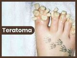 Teratoma: Types, Symptoms, Causes, Diagnosis And Treatment