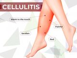 11 Best Home Remedies To Treat Cellulitis