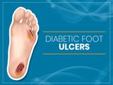 Diabetic Foot Ulcers: Causes, Types, Symptoms, Diagnosis, Treatment And How To Prevent Them