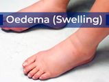 Oedema: Types, Causes, Symptoms, Treatment And Management