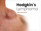 Hodgkin's Lymphoma: Types, Symptoms, Causes, Risk Factors, Diagnosis, Stages, And Treatment