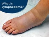 Lymphedema (Lymphatic Dysfunction): Types, Causes, Symptoms, Risk Factors, Diagnosis & Treatment
