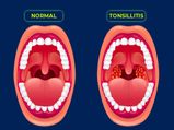 Tonsillitis: Causes, Symptoms, Diagnosis And Treatment