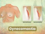 Gynaecomastia (Enlarged Breasts In Men): Causes, Symptoms, Diagnosis And Treatment