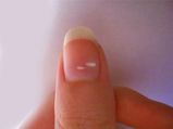 White Spots On Nails ( Leukonychia): Causes, Types, Symptoms, Diagnosis And Treatment