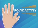 Polydactyly: Causes, Symptoms, Diagnosis And Treatment