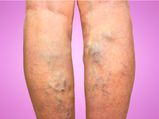 Varicose Veins: Causes, Symptoms, Diagnosis And Treatment