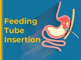 Feeding Tube Insertion (Gastrostomy): Types, Risks, Procedure And Complications
