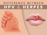 HPV And Herpes: What Are They And How Do They Differ From Each Other?
