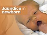 Jaundice In Newborns: Causes, Symptoms, Risk Factors, Diagnosis And Treatment