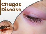Chagas Disease: Causes, Symptoms, Risk Factors, Treatment And Prevention