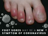 Foot Sores May Be A New Symptom Of Coronavirus, Here's What You Need To Know