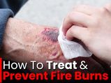 Fire Burns: Treatment And Prevention Tips