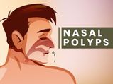 Nasal Polyps: Is It A Serious Condition? Know About Its Causes, Symptoms And Treatment