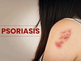 Psoriasis: Types, Causes, Symptoms, Risk Factors, Diagnosis And Treatment