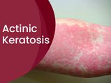 Actinic Keratosis: Causes, Symptoms, Risk Factors, Treatments And Prevention