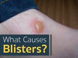 Blisters: Causes, Symptoms, Treatment And Prevention