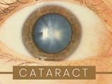 Cataract: Types, Causes, Symptoms, Diagnosis And Treatment