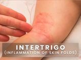 Intertrigo (Inflammation Of Skin Folds): Causes, Symptoms, Risk Factors, Treatments And Prevention