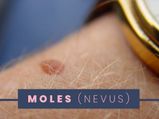 Moles: Types, Causes, Symptoms, Risk Factors, Treatments And Prevention