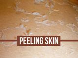 Peeling Skin: Causes, Symptoms, Diagnosis And Treatment