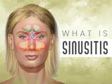 What Is Sinusitis? Causes, Symptoms, Risk Factors, Diagnosis And Treatment