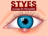 Stye (Lump On The Eyelid): Causes, Symptoms, Risk Factors, Complication, Treatments And Prevention