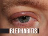 Blepharitis (Eyelid Inflammation): Causes, Types, Symptoms, Diagnosis & Treatment