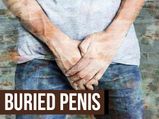 Buried Penis: Causes, Complications, Diagnosis And Treatment