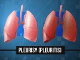 Pleurisy (Inflammation Of The Lung Lining): Symptoms, Causes, Treatments and Prevention