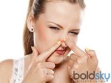 5 Effective Remedies For Acne On Nose
