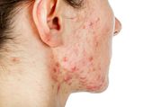 6 Effective Home Remedies For Cystic Acne