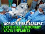 Indian Hospital Succeeds In World’s Largest Artificial Pulmonary Valve Without Surgery