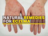 8 Effective Natural Remedies That Can Help Manage Eczema Symptoms