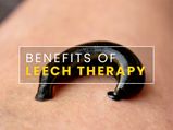 What Is Leech Therapy? Proven Health Benefits And Side Effects